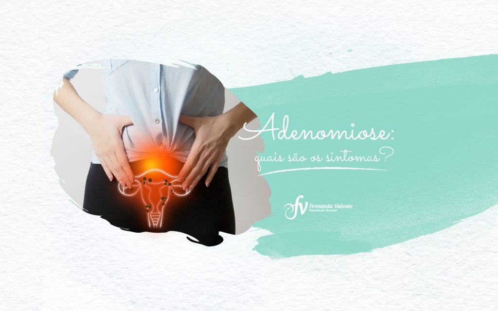 Adenomiose: conheça os sintomas