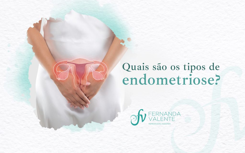 Endometriomas: o que são? - Art Fértil