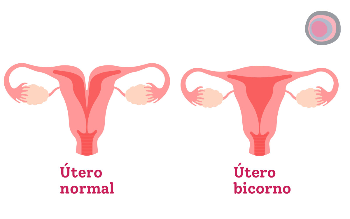 Malformações uterinas: como ocorrem?