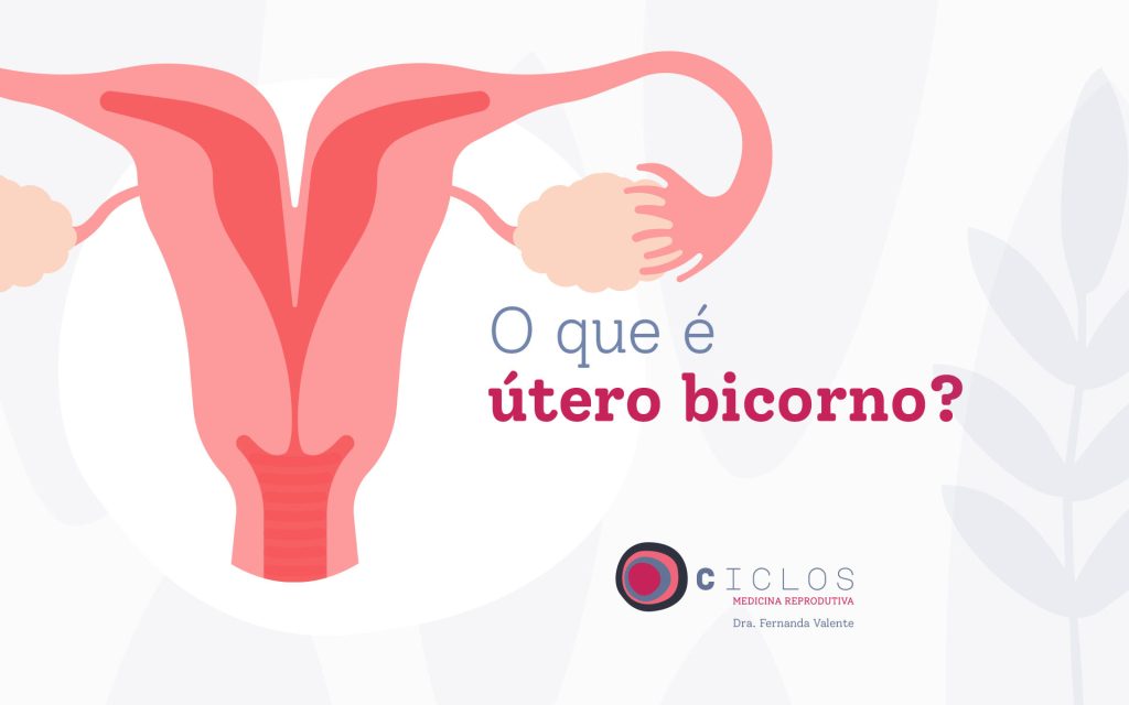 Malformações uterinas: como ocorrem?