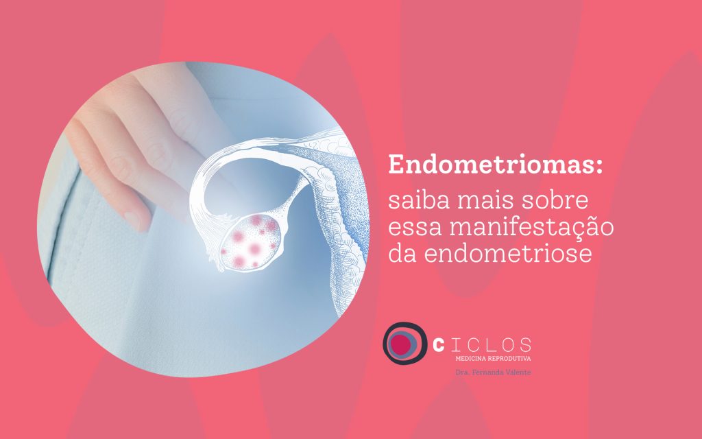Hidrossalpinge: saiba tudo sobre a doença