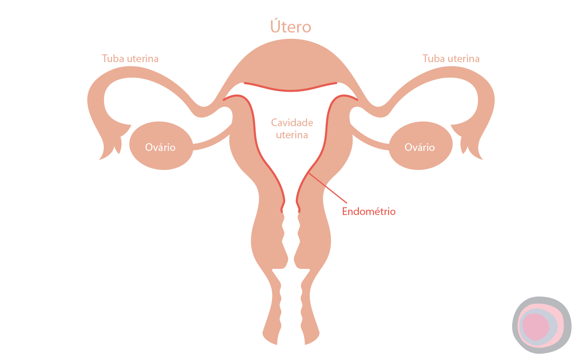 Endometrite: como é feito o tratamento